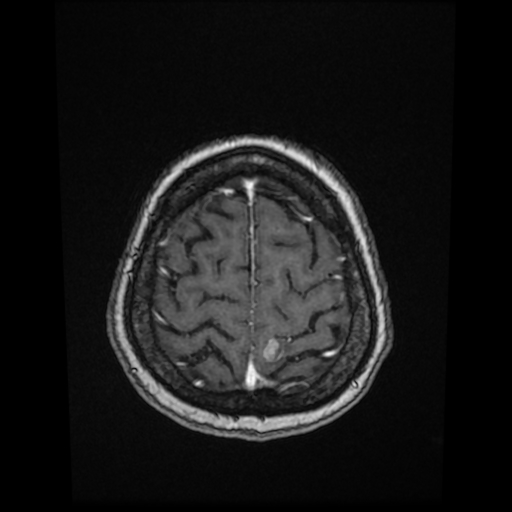 Cerebral metastases - melanoma (Radiopaedia 80972-94522 Axial T1 C+ 80).jpg