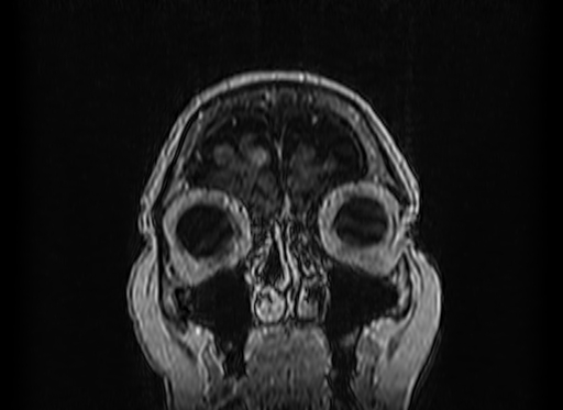 Cerebral metastases from lung cancer with amyloid angiopathy and cerebellopontine angle meningioma (Radiopaedia 74306-85191 Coronal T1 C+ 4).jpg