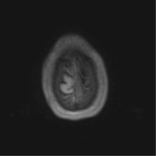 Cerebral metastasis - melanoma (Radiopaedia 54718-60954 Axial T1 49).png