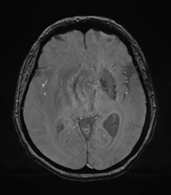 File:Cerebral metastasis to basal ganglia (Radiopaedia 81568-95413 Axial SWI magnitude 40).png