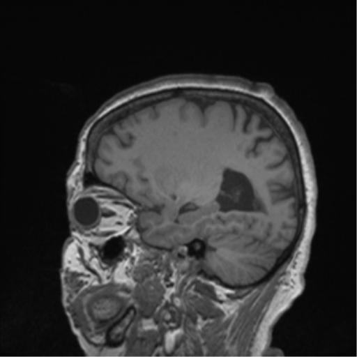 Cerebral metastasis to basal ganglia (Radiopaedia 81568-95413 Sagittal T1 21).png