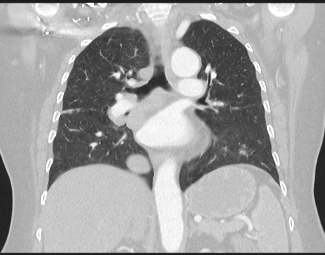 File:Cerebral metastasis to basal ganglia (Radiopaedia 81568-95414 Coronal lung window 49).png