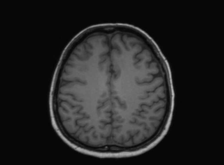 Cerebral ring enhancing lesions - cerebral metastases (Radiopaedia 44922-48817 Axial T1 173).jpg