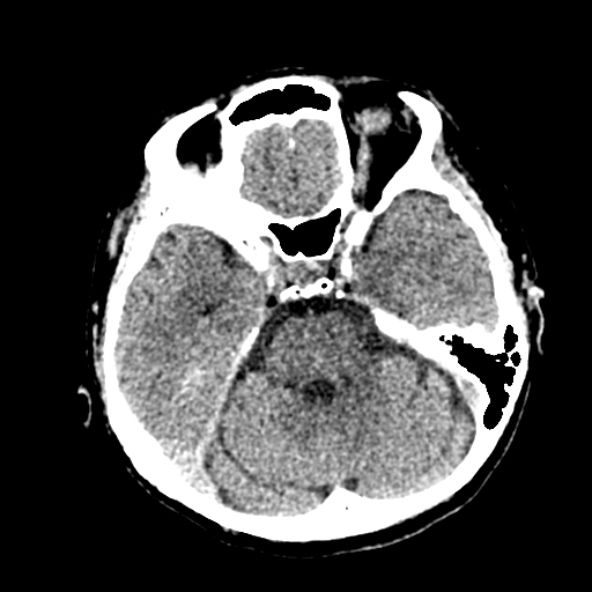 Cerebral ring enhancing lesions - cerebral metastases (Radiopaedia 44922-48818 Axial non-contrast 39).jpg