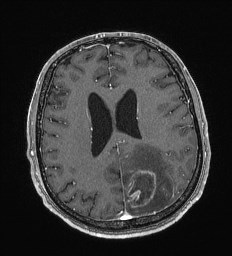 Cerebral toxoplasmosis (Radiopaedia 43956-47461 Axial T1 C+ 49).jpg
