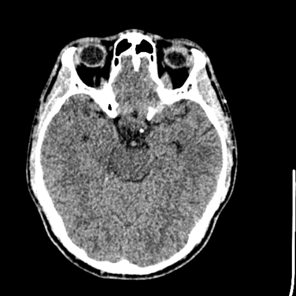 Cerebral toxoplasmosis (Radiopaedia 53993-60131 Axial non-contrast 31).jpg