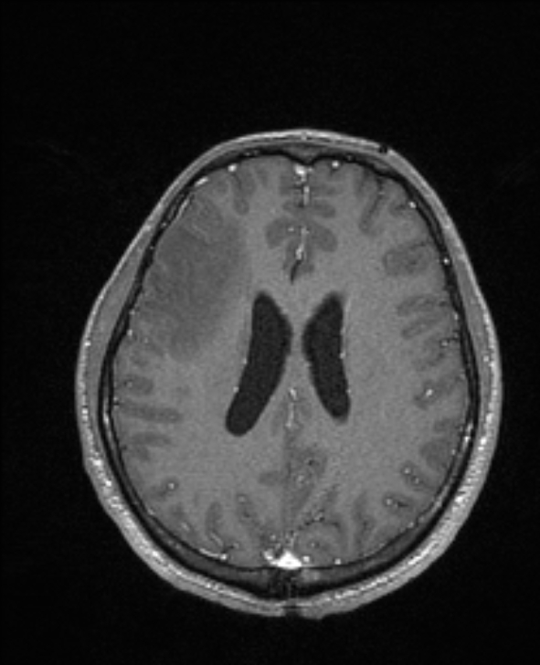 Cerebral toxoplasmosis (Radiopaedia 85779-101597 Axial T1 C+ 106).jpg