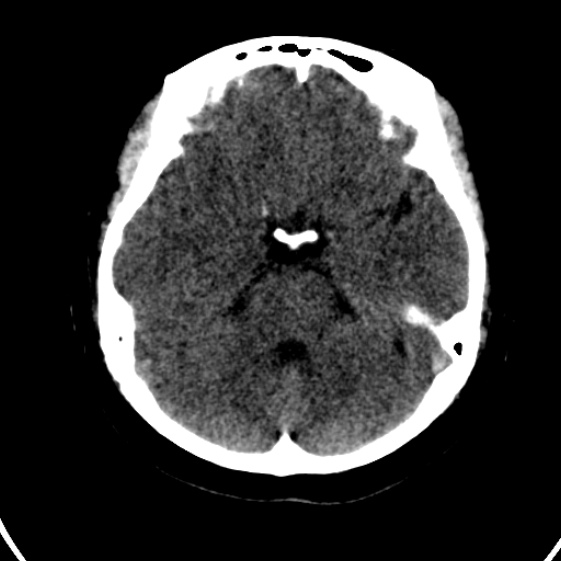 File:Cerebral venous hemorrhagic infarct from venous sinus thrombosis (Radiopaedia 55433-61879 Axial non-contrast 7).jpg