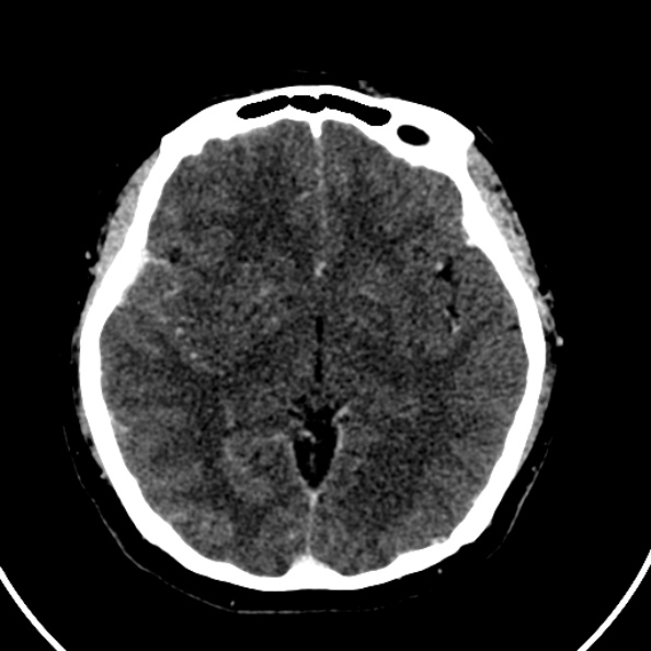 File:Cerebral venous hemorrhagic infarct from venous sinus thrombosis (Radiopaedia 55433-61883 Axial C+ delayed 81).jpg