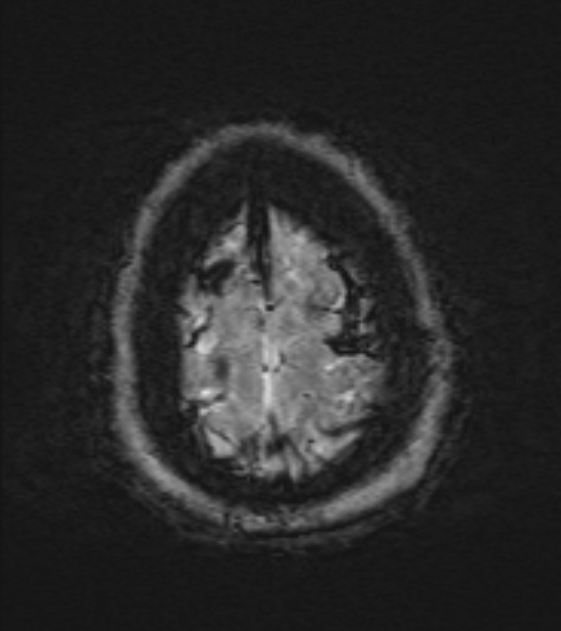 Cerebral venous infarct (Radiopaedia 53627-59685 Axial SWI 52).jpg