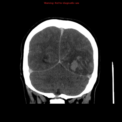 Cerebral venous infarction (Radiopaedia 12404-20735 B 64).jpg