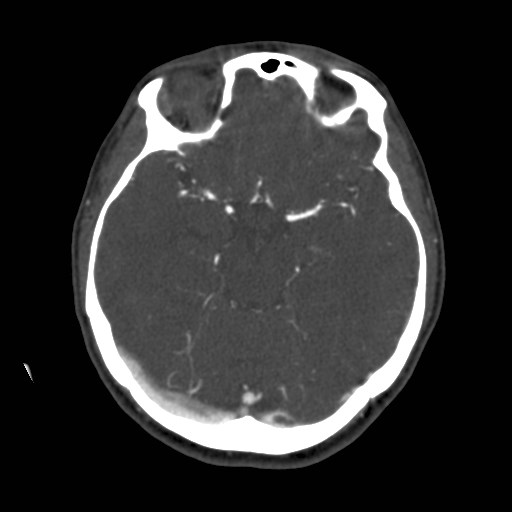 Cerebral venous sinus thrombosis (Radiopaedia 40619-43227 A 89).jpg