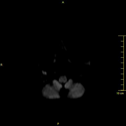 File:Cerebral venous thrombosis (Radiopaedia 23288-23351 Axial DWI 1).JPG