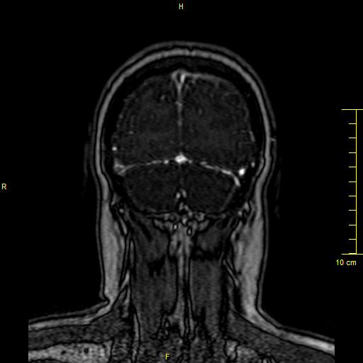 Cerebral venous thrombosis (Radiopaedia 23288-23351 MRV 154).JPG