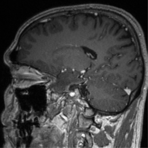 Cerebral venous thrombosis (Radiopaedia 38392-40469 Sagittal T1 C+ 55).png