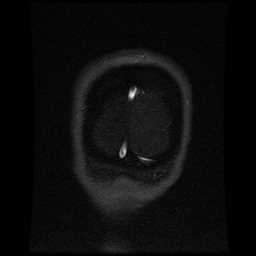 Cerebral venous thrombosis - ulcerative colitis (Radiopaedia 66049-75219 Coronal MRV 10).jpg