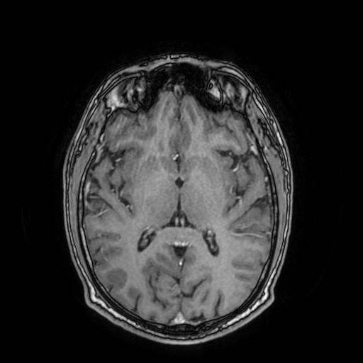File:Cerebral venous thrombosis with secondary intracranial hypertension (Radiopaedia 89842-106957 Axial T1 C+ 97).jpg