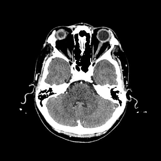 File:Cerebral venous thrombosis with venous hemorrhagic infarct (Radiopaedia 90354-107660 Axial with contrast 48).jpg