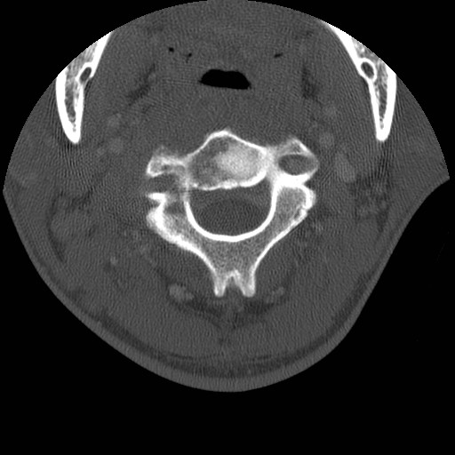 Cervical Pott disease (Radiopaedia 20374-20286 Axial bone window 40).jpg