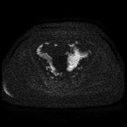 File:Cervical carcinoma (Radiopaedia 85405-101028 Axial DWI 55).jpg