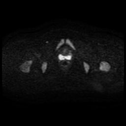 Cervical carcinoma (Radiopaedia 88010-104555 Axial DWI 43).jpg