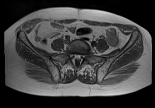File:Cervical carcinoma (Radiopaedia 88312-104943 Axial T1 4).jpg