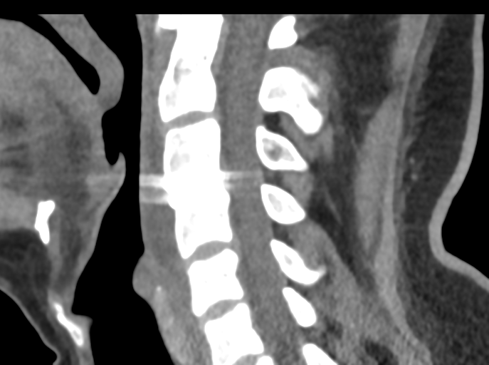 Cervical disc replacement (Radiopaedia 44025-47541 B 51).png