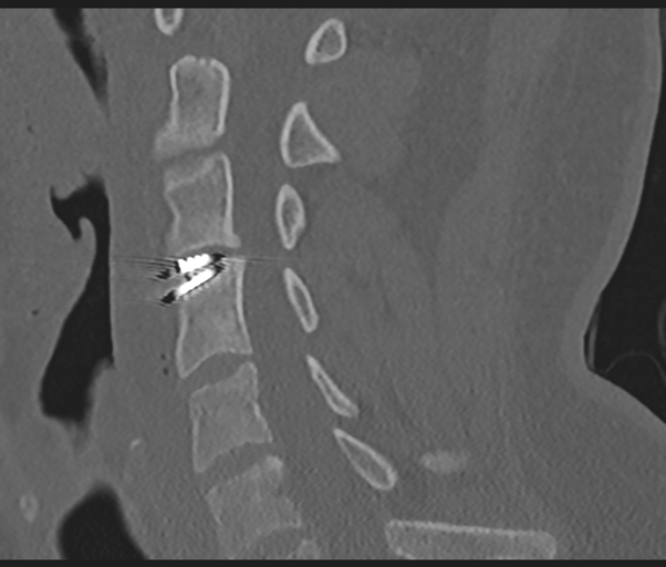 Cervical disc replacement (Radiopaedia 44025-47541 Sagittal bone window 38).png