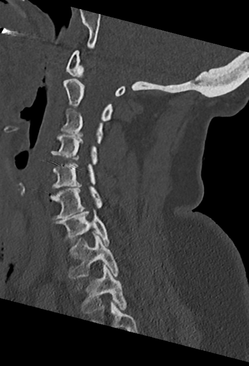 Cervical spine ACDF loosening (Radiopaedia 48998-54070 Sagittal bone window 38).png