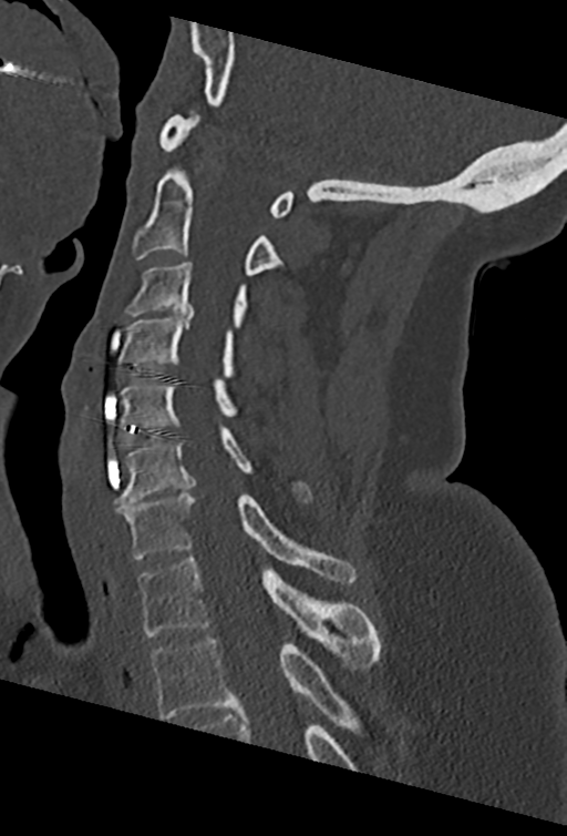 Cervical spine ACDF loosening (Radiopaedia 48998-54070 Sagittal bone window 48).png