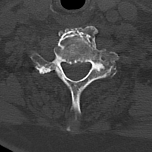 File:Cervical spine fracture - chalk stick (Radiopaedia 39116-41323 Axial bone window 70).png