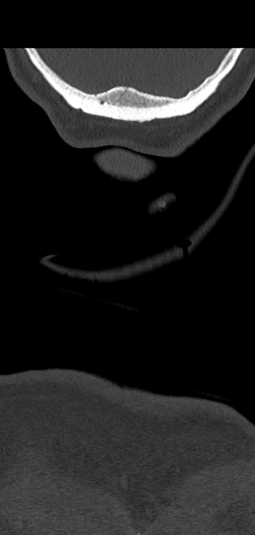 Cervical spine fracture - chalk stick (Radiopaedia 39116-41323 Coronal bone window 68).png