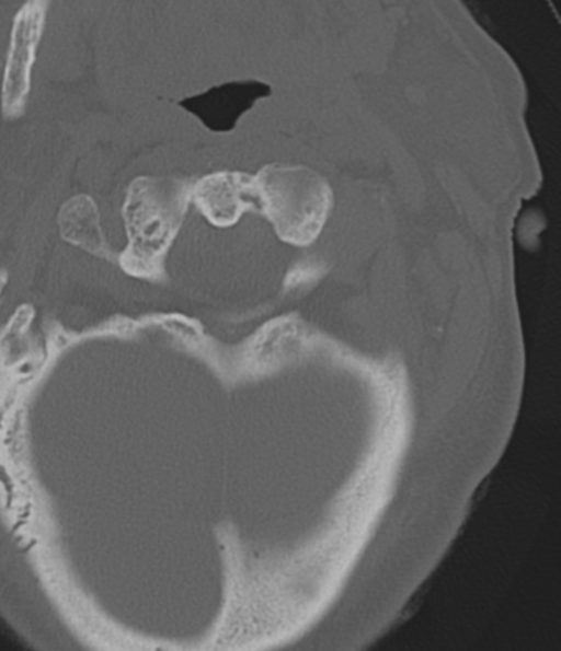File:Cervical spine fracture in the setting of ankylosis (Radiopaedia 37038-38715 Axial bone window 15).png