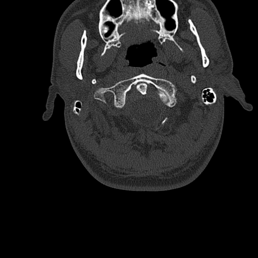 File:Cervical spine trauma with tear drop fracture and perched facet joint (Radiopaedia 53989-60127 Axial bone window 7).jpg