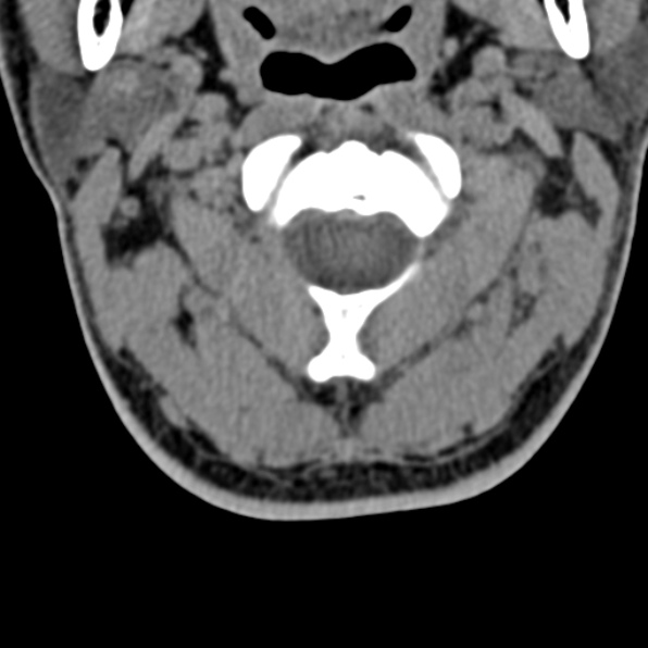 Cervical spondylodiscitis (Radiopaedia 28057-29489 Axial non-contrast 22).jpg