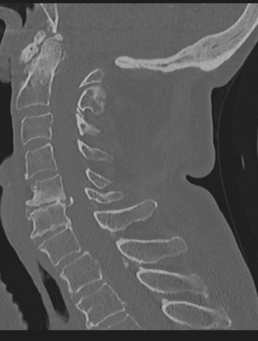 Cervical spondylolysis (Radiopaedia 49616-54811 Sagittal bone window 38).png