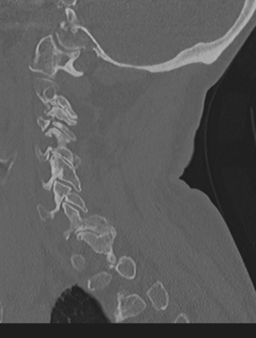 Cervical spondylolysis (Radiopaedia 49616-54811 Sagittal bone window 51).png