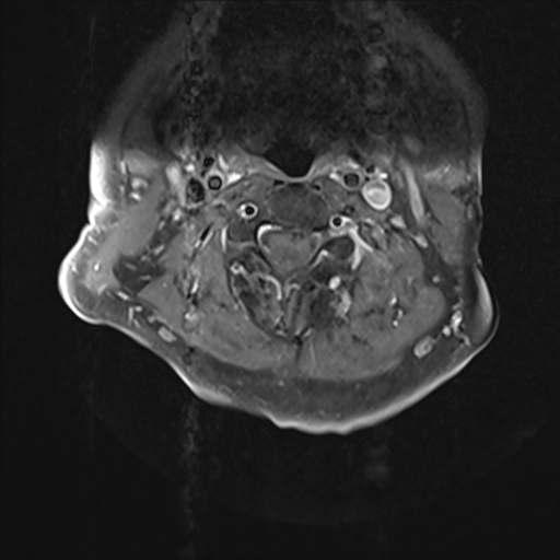 File:Cervical tumor-like myelopathy due to Type V dAVF (Radiopaedia 82461-96604 Axial T1 C+ fat sat 12).jpg