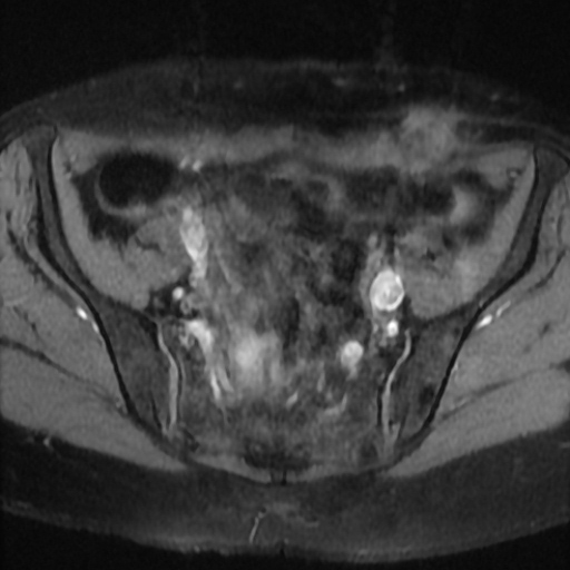 File:Cesarian section scar endometriosis (Radiopaedia 66520-75799 Axial T1 fat sat 7).jpg