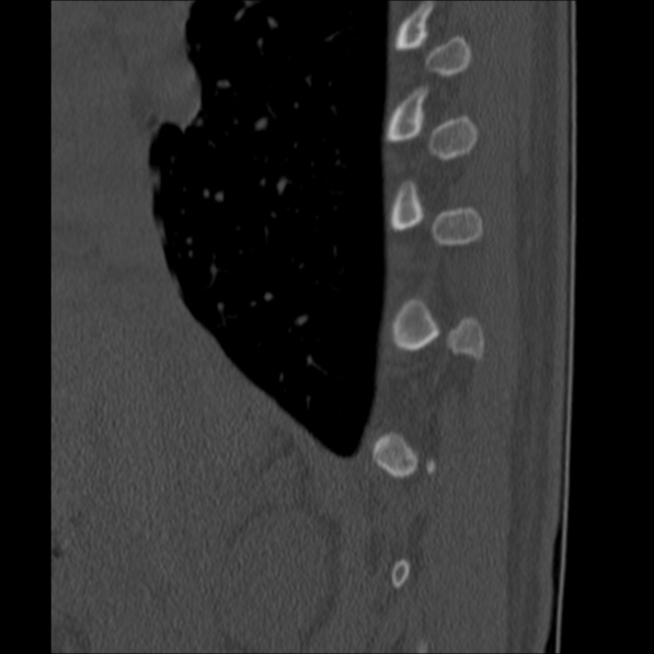 Chance fracture (Radiopaedia 36521-38081 Sagittal bone window 7).jpg