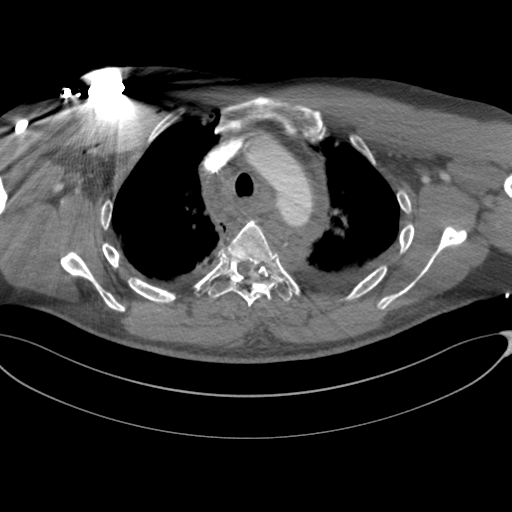 File:Chest multitrauma - aortic injury (Radiopaedia 34708-36147 A 84).png