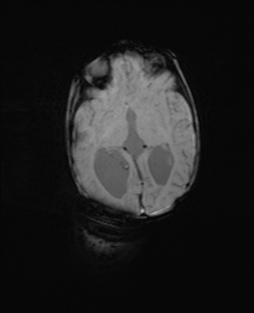 Chiari III malformation with occipital encephalocele (Radiopaedia 79446-92559 Axial SWI 36).jpg