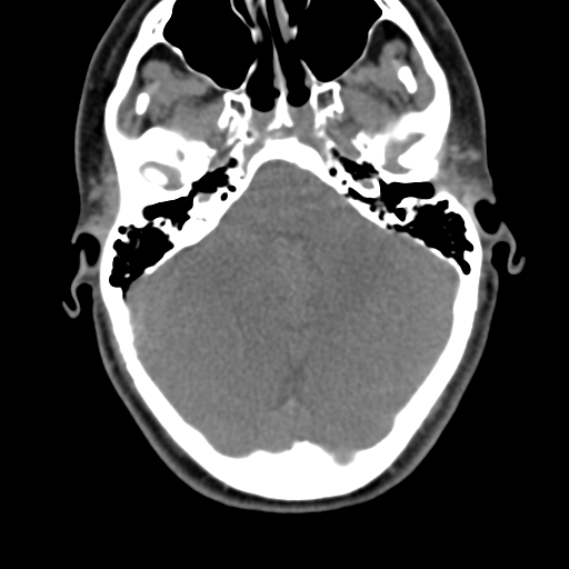 Chiari I malformation and obstructive hydrocephalus (Radiopaedia 41185-43981 D 24).png