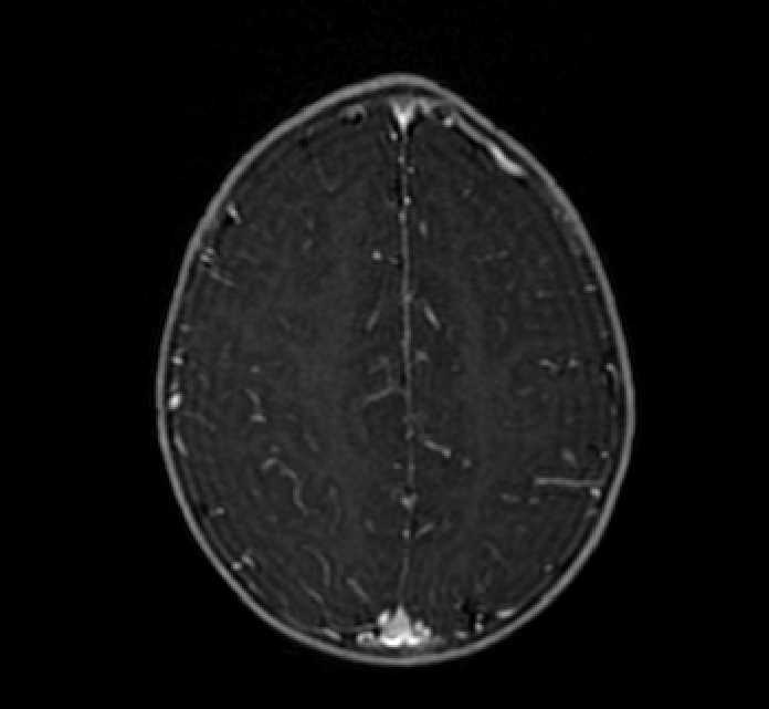 Chiasmatic-hypothalamic glioma (Radiopaedia 90079-107252 Axial T1 C+ 71).jpg