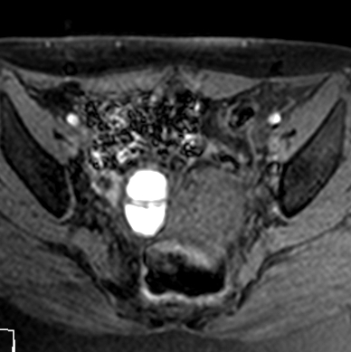 File:Chocolate cysts (endometriomata) (Radiopaedia 25072-25329 Axial T1 fat sat 1).jpg