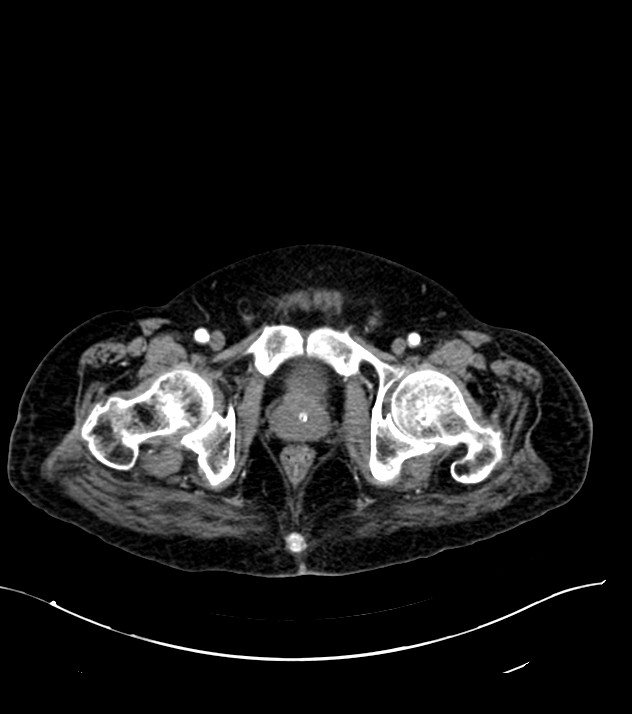 Cholangiocarcinoma with cerebral metastases (Radiopaedia 83519-98629 B 123).jpg