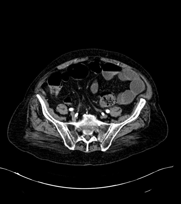 Cholangiocarcinoma with cerebral metastases (Radiopaedia 83519-98629 B 93).jpg