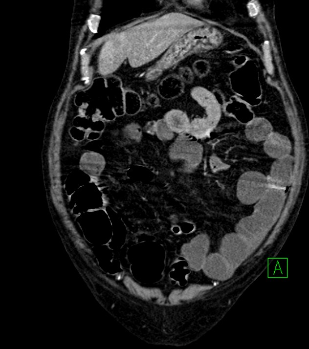 Cholangiocarcinoma with cerebral metastases (Radiopaedia 83519-98629 E 23).jpg