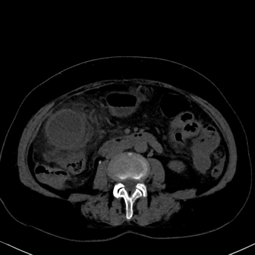 File:Cholecystitis - obstructive choledocholitiasis (CT intravenous cholangiography) (Radiopaedia 43966-47479 Axial 136).png