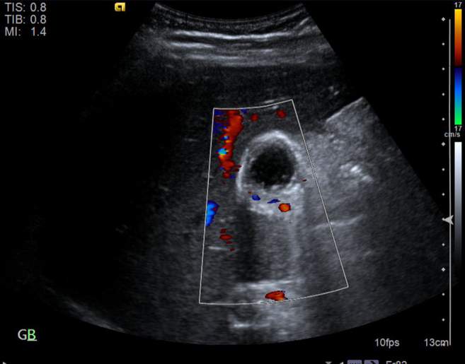 File:Cholecystitis - perforated gallbladder (Radiopaedia 57038-63913 A 17).jpg